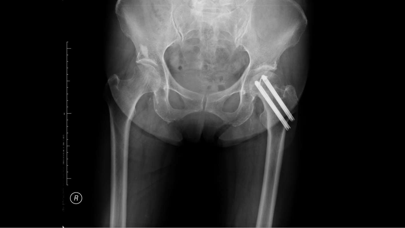 （图片）股骨粗隆间骨折的治疗 - 好大夫在线