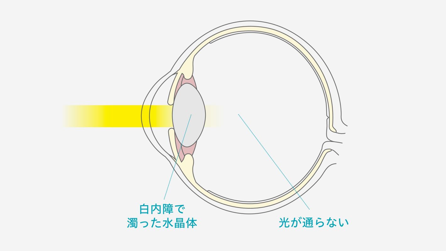 白内障について