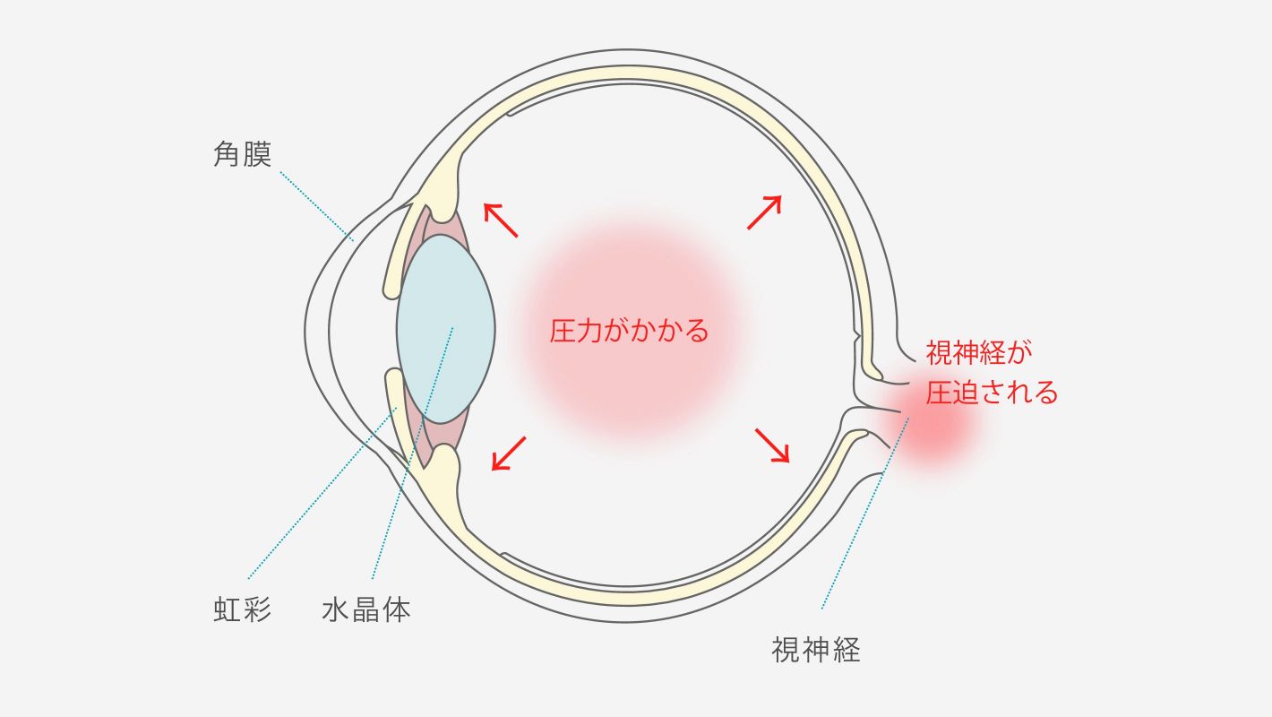 緑内障について