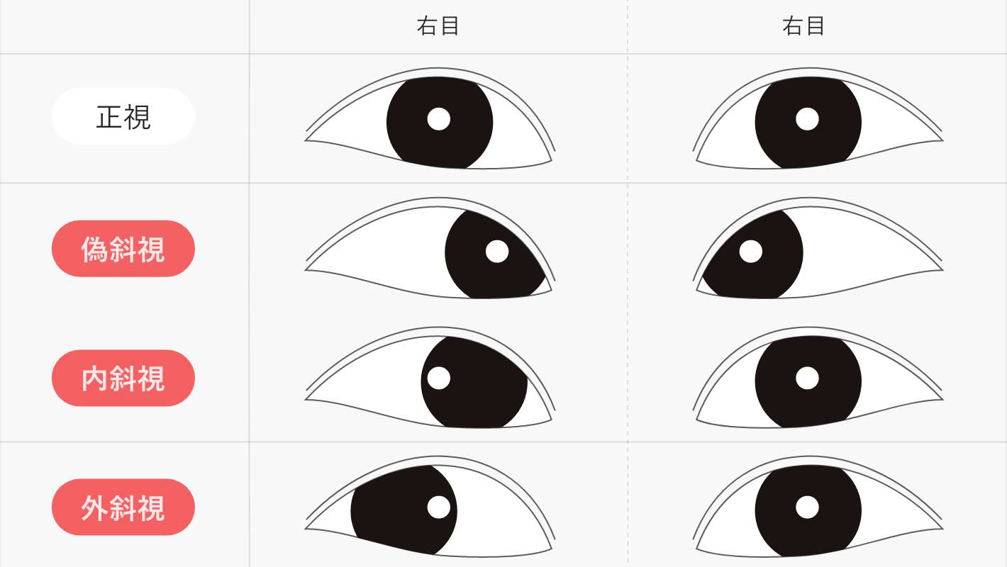 斜視、弱視について