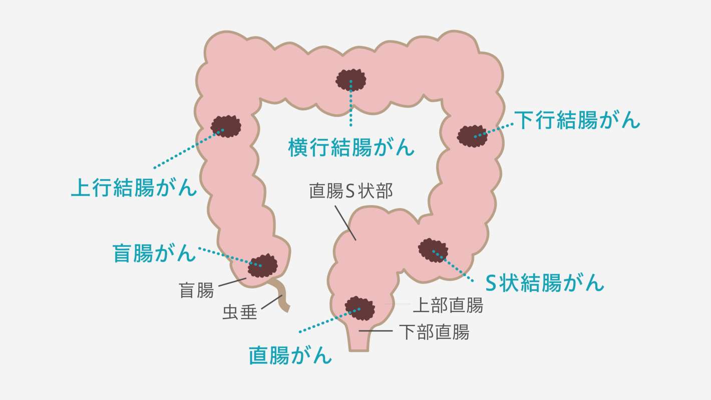 大腸がんの治療について