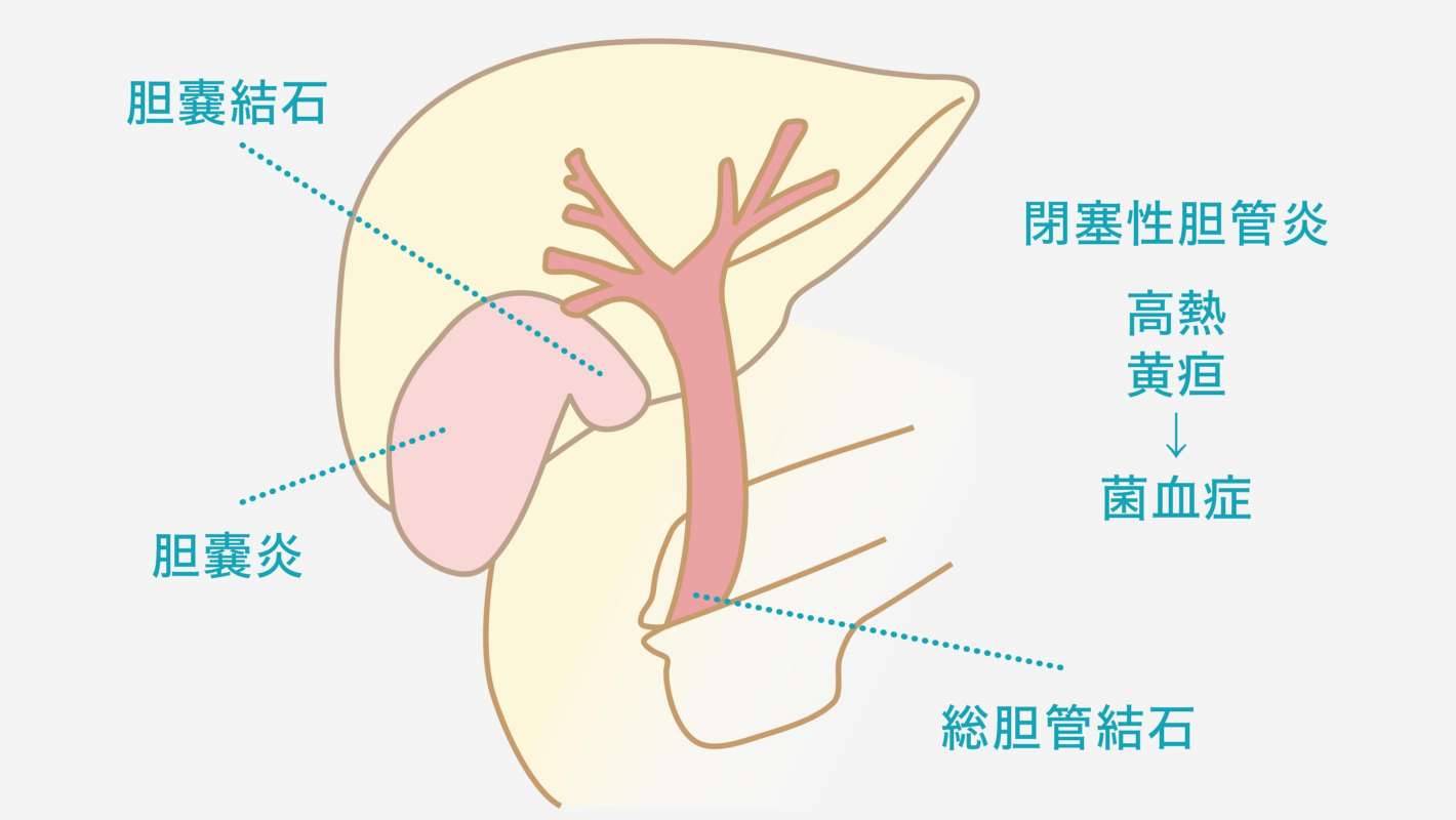 胆石の治療について