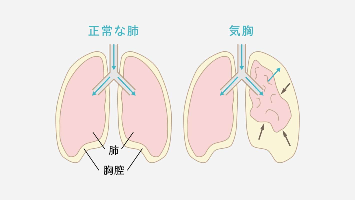 肺疾患の治療について