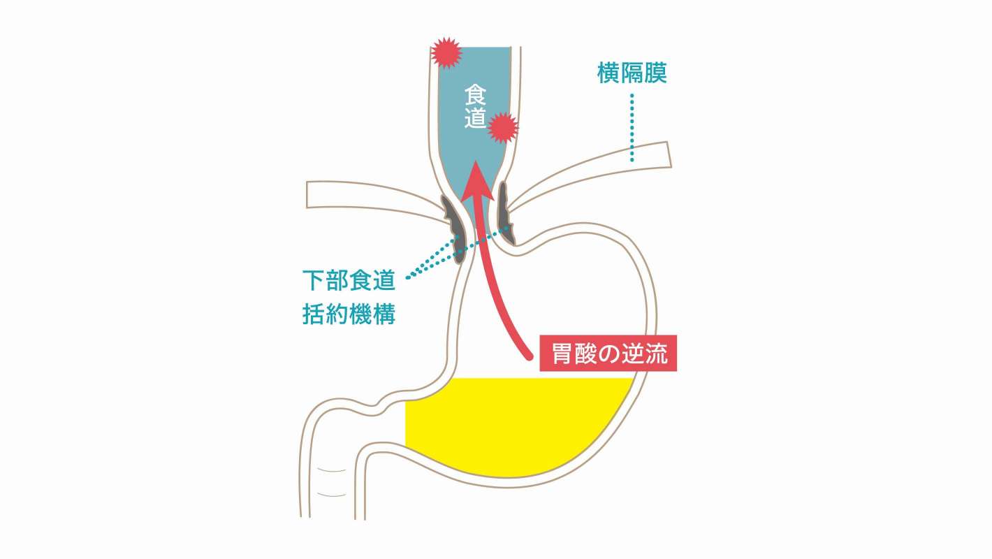 逆流性食道炎の治療について