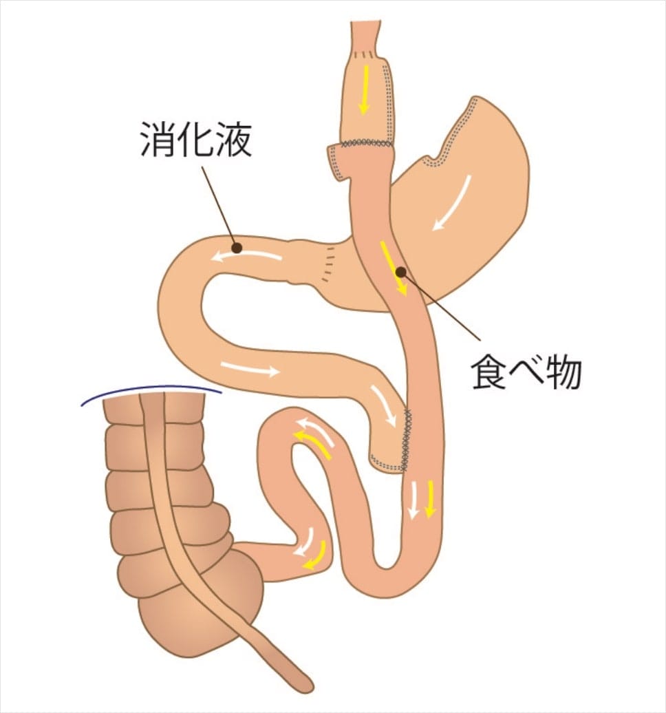 腹腔鏡下胃バイパス（ルーワイ胃バイパス）