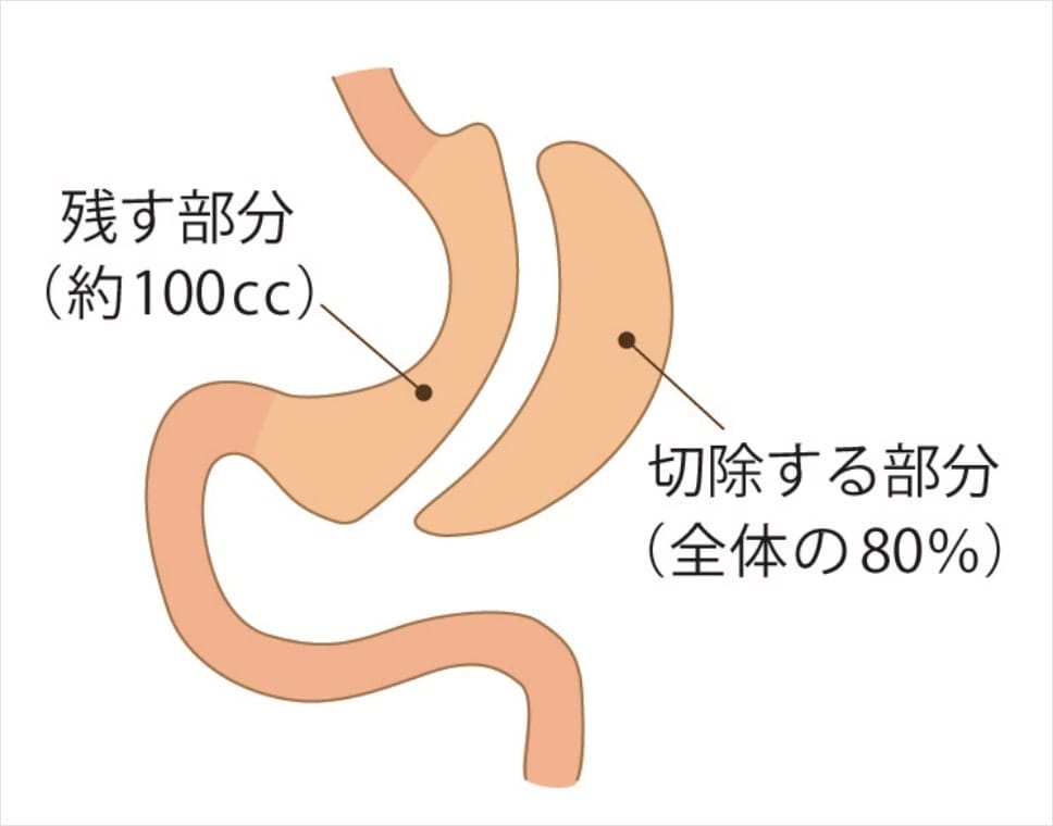 腹腔鏡下スリーブ状胃切除術（スリーブ術）