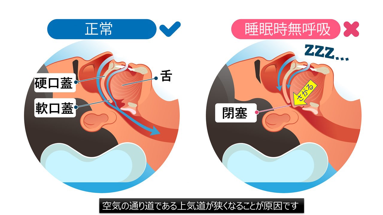 睡眠時無呼吸症候群 