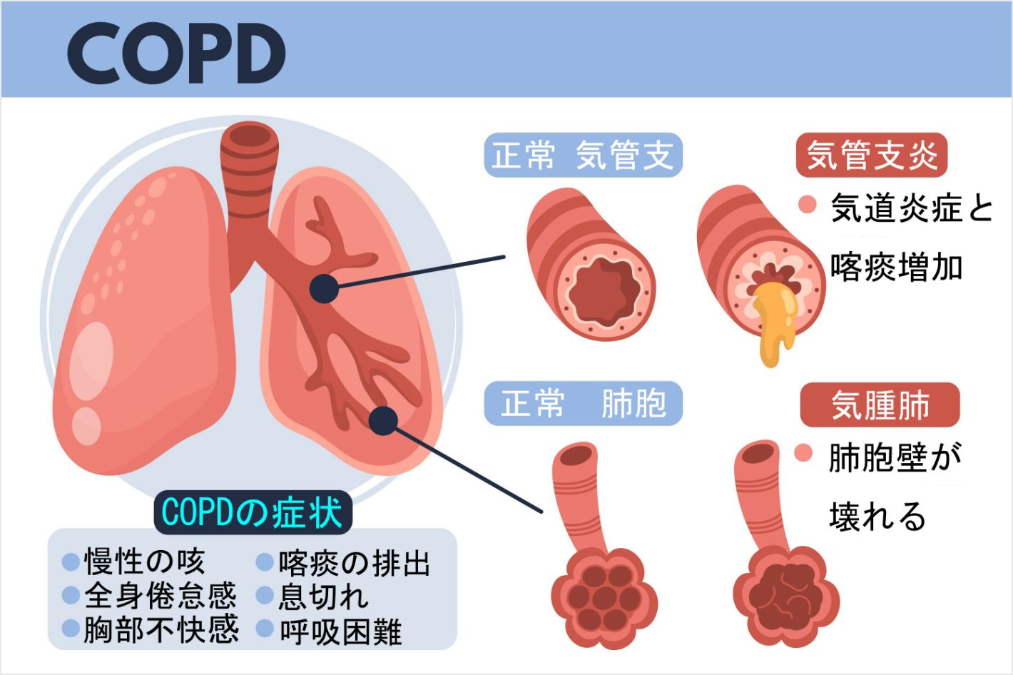 copd と 肺気腫 の 違い