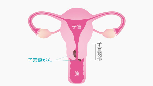 子宮頸がんの治療