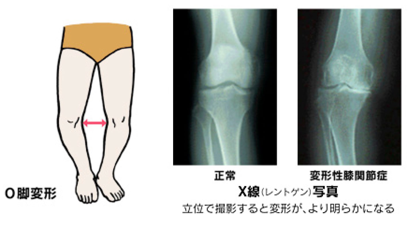 変形性膝関節症の治療