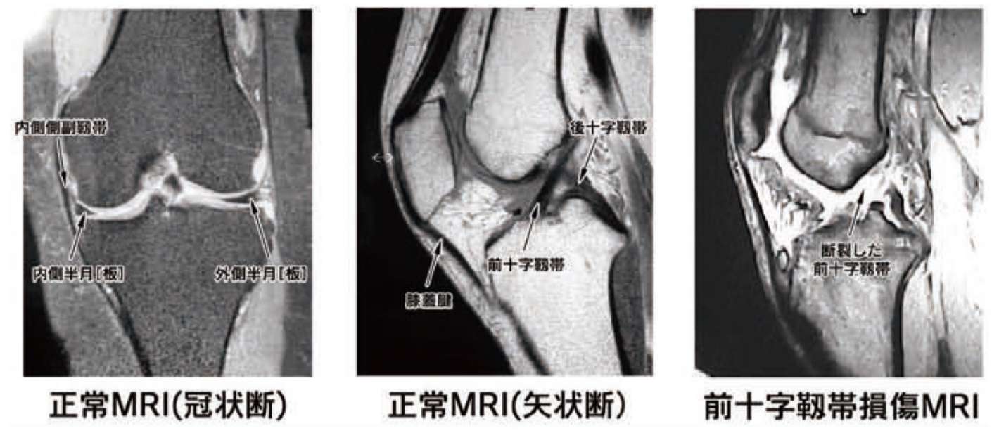 膝前十字靱帯損傷の治療 整形外科 千船病院 大阪市