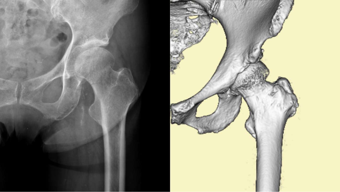 大腿骨近位部骨折の治療｜整形外科｜千船病院【大阪市】