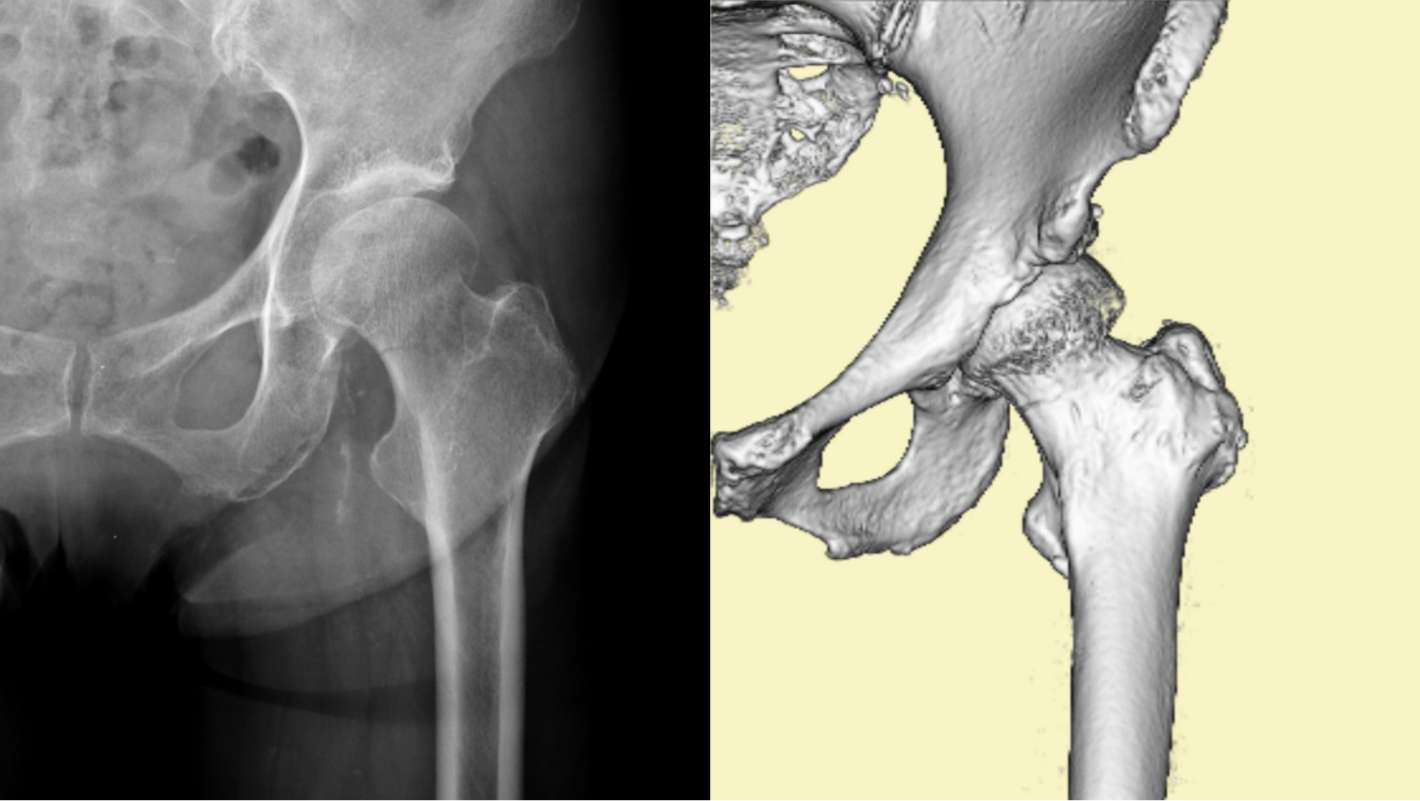 大腿骨はどのように折れるのでしょうか?
