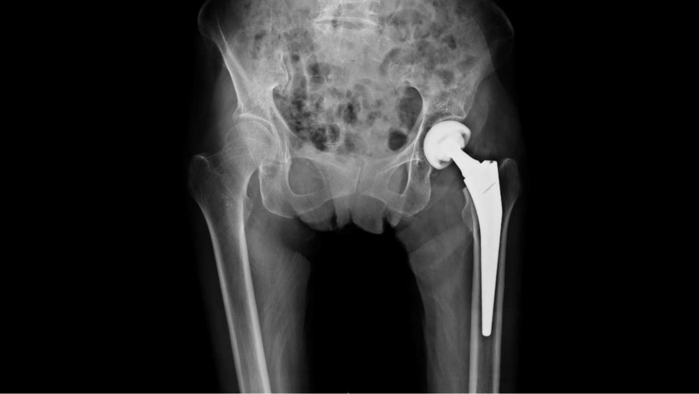 大腿骨骨折の診断