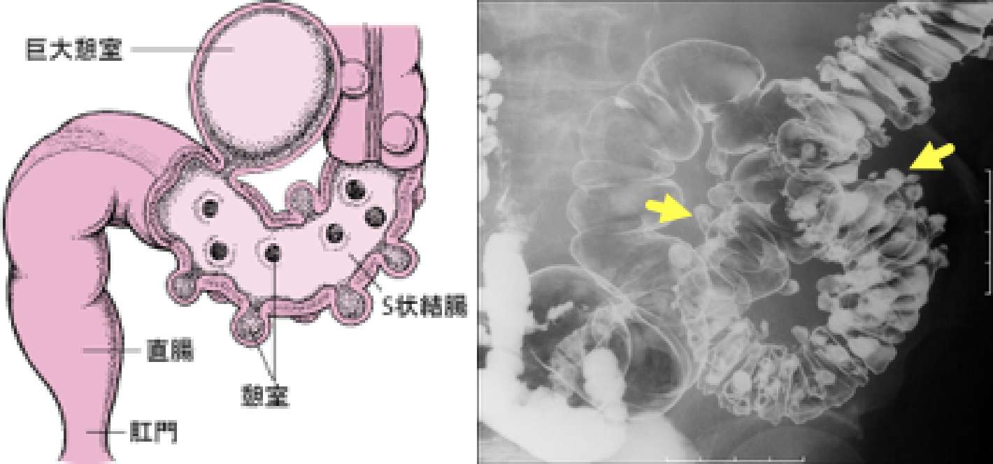 再発 憩室 炎