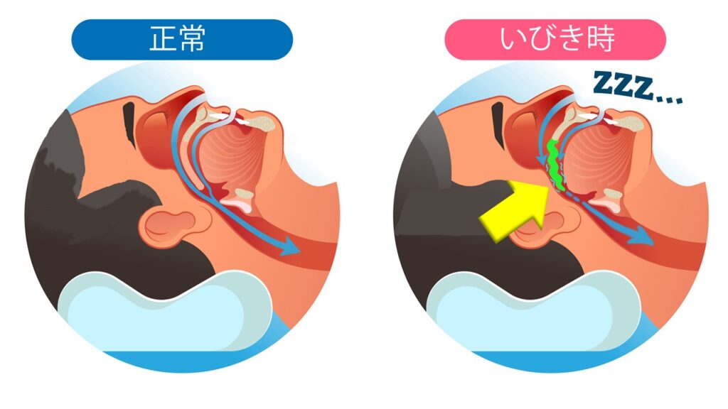 　いびきはどうして起こるのですか？