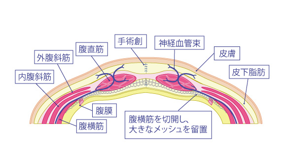 腹壁瘢痕ヘルニアには、どんな治療があるの？