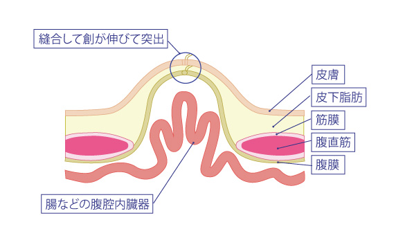 腹壁瘢痕ヘルニアってなに？