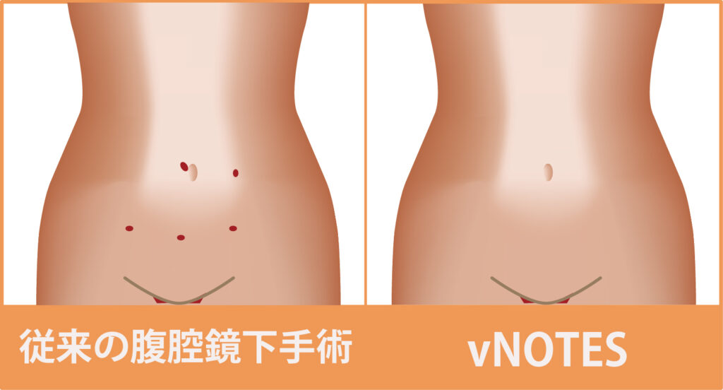 従来の手術と比較して、より低侵襲な手法です。 