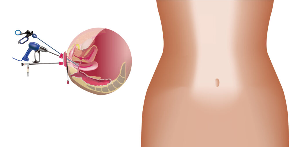 お腹を全く切らない経腟的婦人科腹腔鏡下手術です。