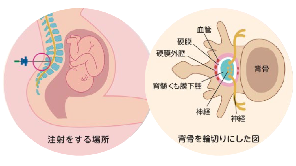 無痛分娩ってどんなもの？