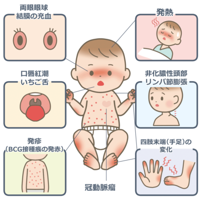 川崎病の症状は？