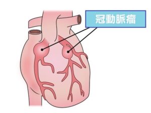 川崎病って？