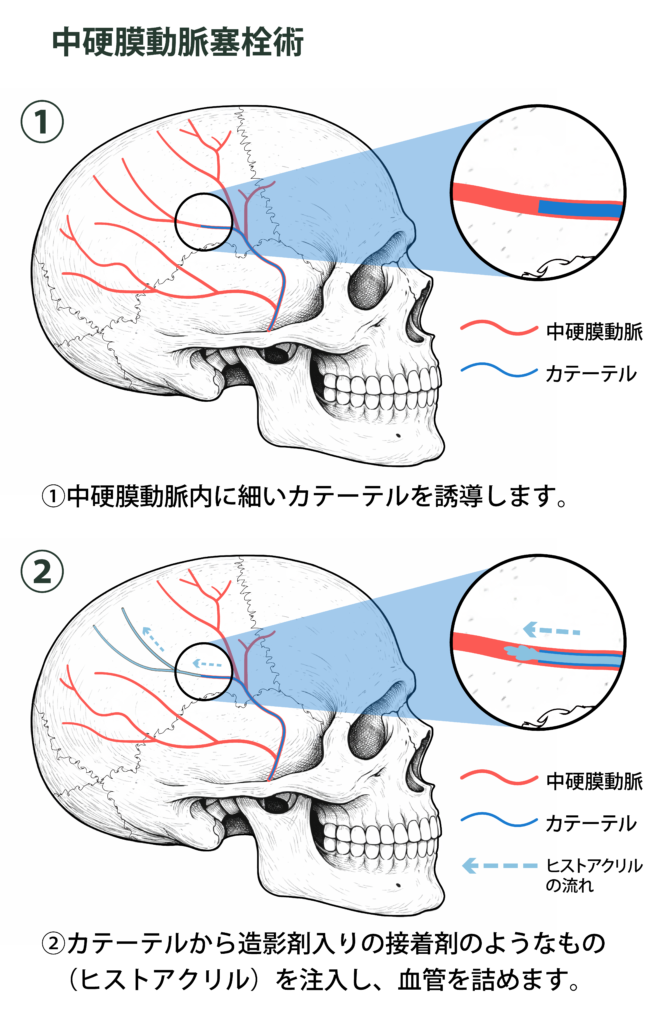慢性硬膜下血腫への新しい治療法