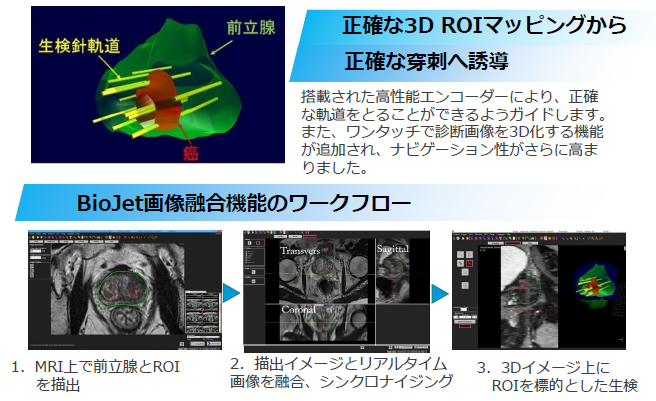 MRIフュージョン生検はなにが良いの?